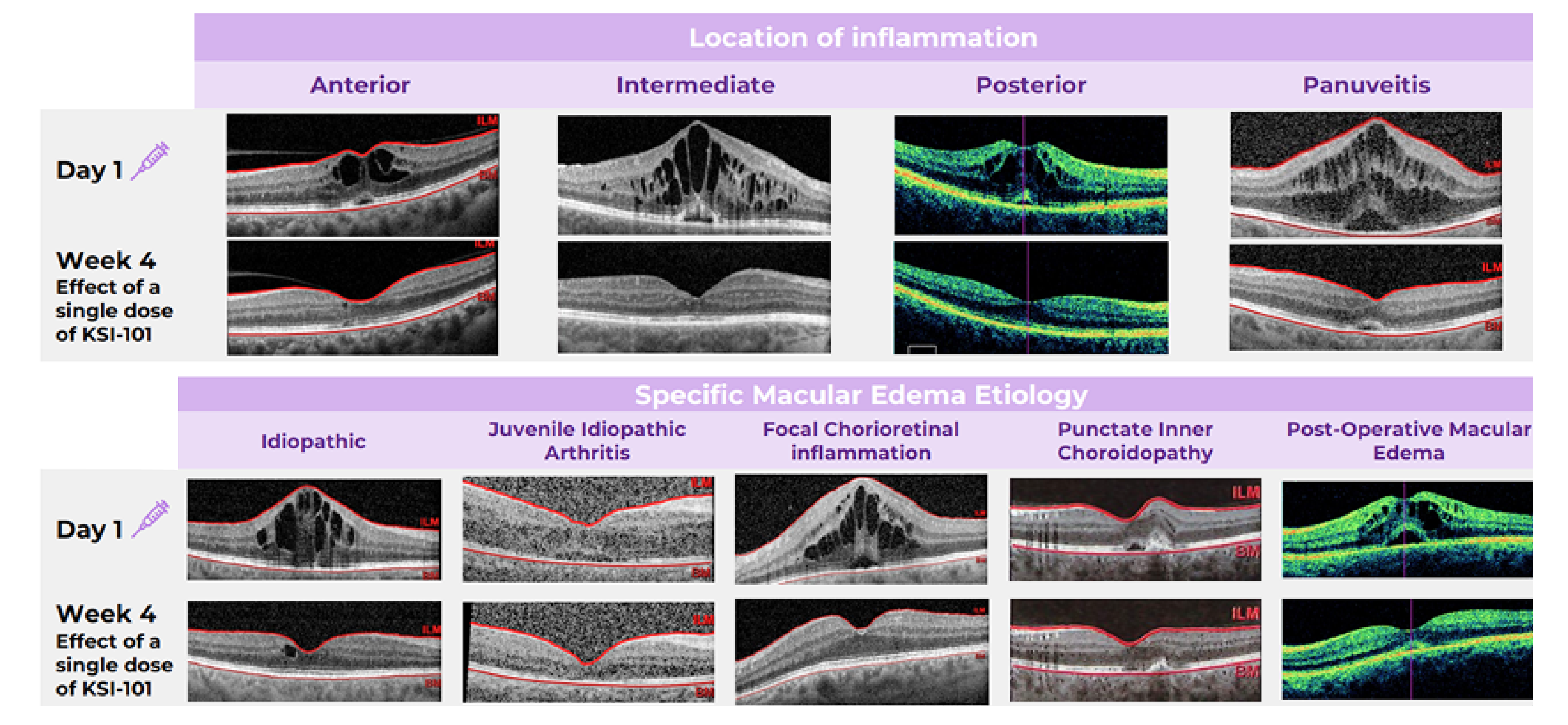 APEX Phase 1b OCT images by location of inflammation (anterior, intermediate, posterior, panuveitis) at Day 1 and Week 4 after a single dose of KSI-101