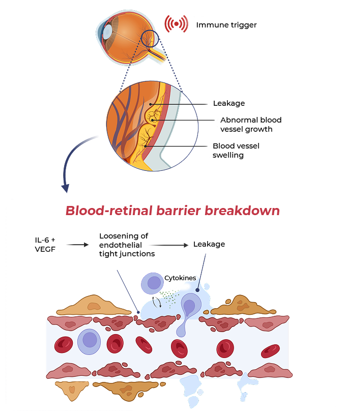 Diagram showing the pathogenesis of macular edema secondary to inflammation (MESI)